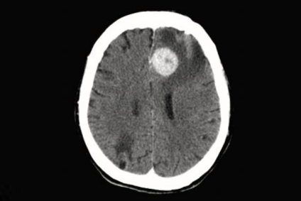 Linfoma cerebral